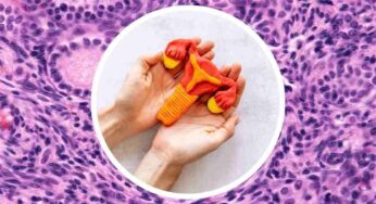 Tumore dell’ovaio, conoscere i primi sintomi è importantissimo: ecco a cosa fare massima attenzione